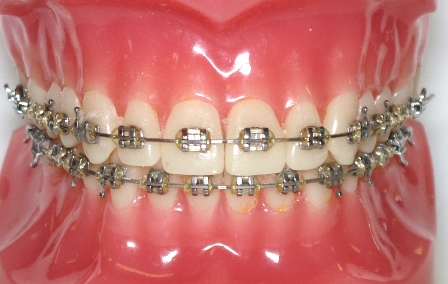wire_braces